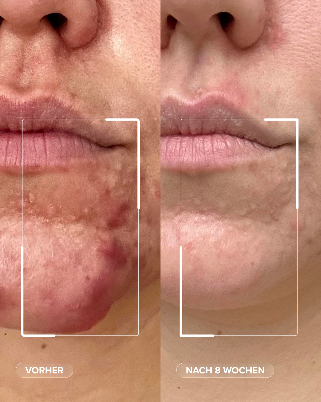 Dermabacs®