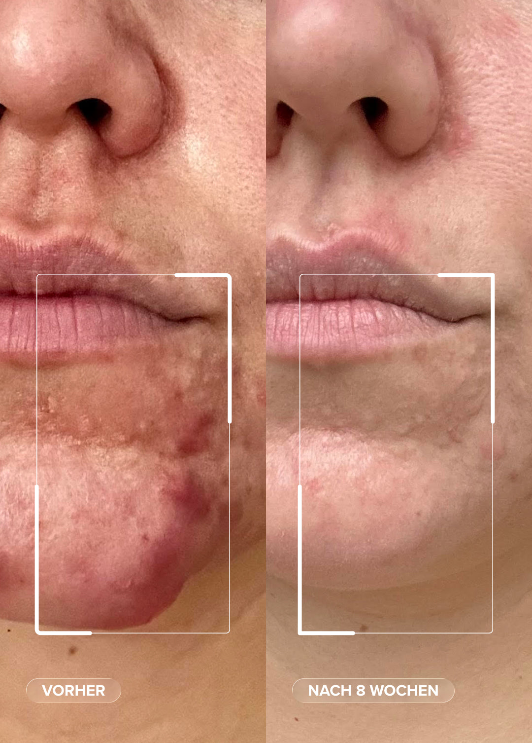 Dermabacs®