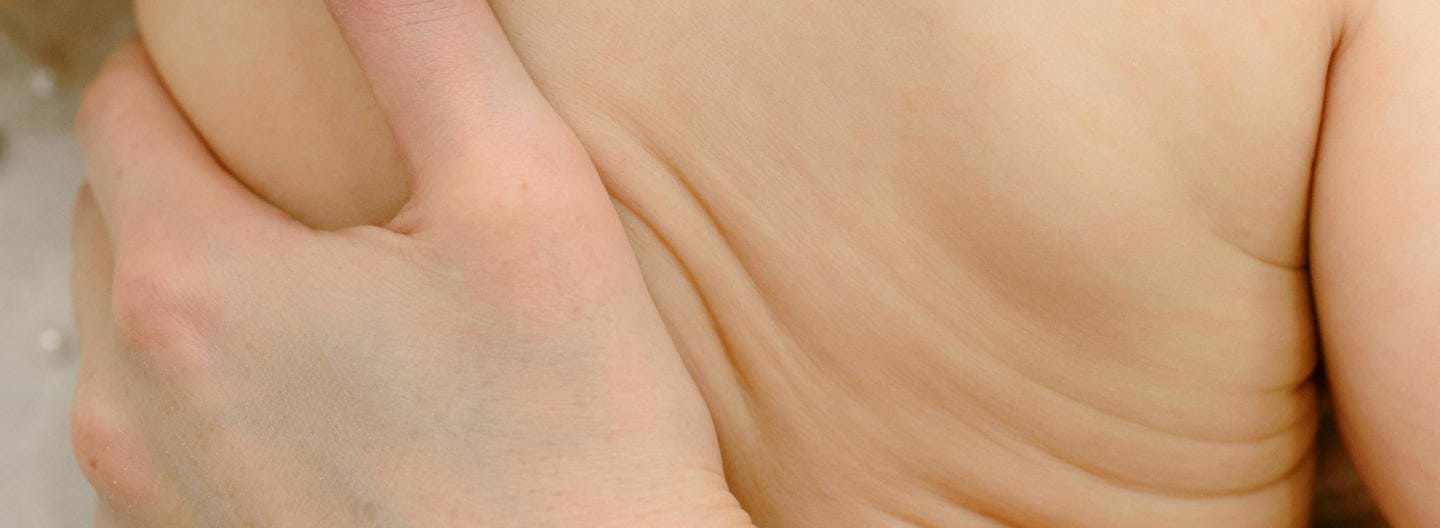 Neurodermatitis en niños: ¿Pueden ayudar los probióticos?