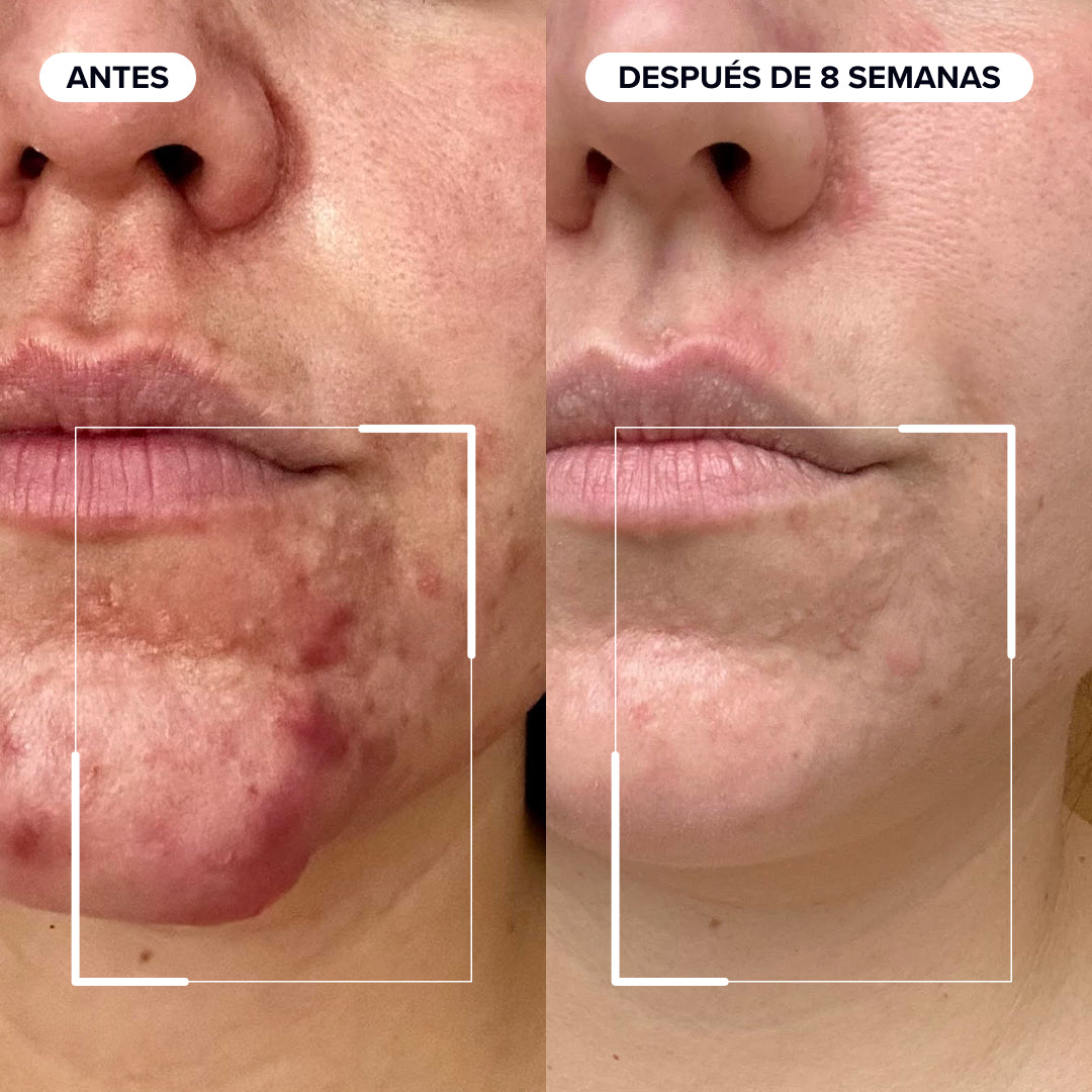 Comparativa de la piel antes y después con Dermabacs tras 8 semanas, cutis visiblemente más uniforme en la zona de la barbilla

