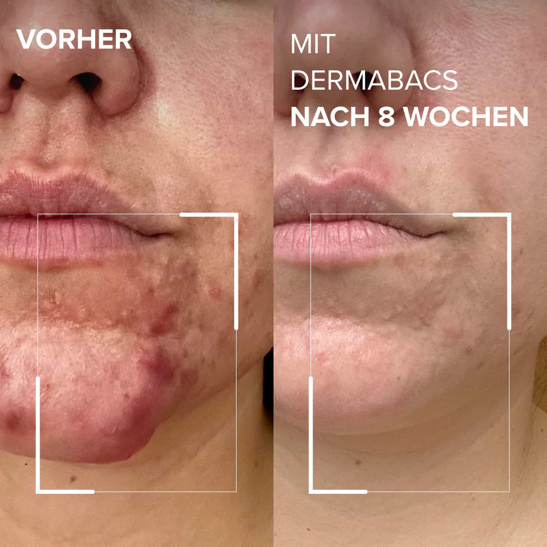 Vorher-Nachher Vergleich der Haut mit Dermabacs® nach 8 Wochen  Unterschied im Hautbild erkennbar.
