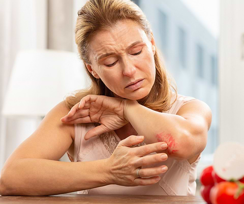woman with skin rash or dermatitis as a symptom of gluten sensitivity