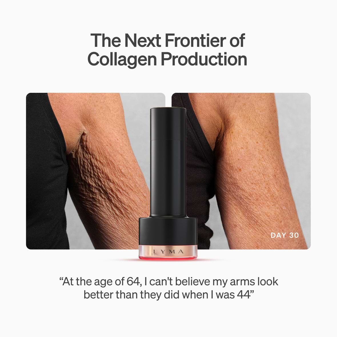 Before after sagging skin under arm 30 days results Laser PRO PDP ALL TEXT 6 Before after sagging skin under arm 30 days results Laser PRO PDP ALL TEXT 6