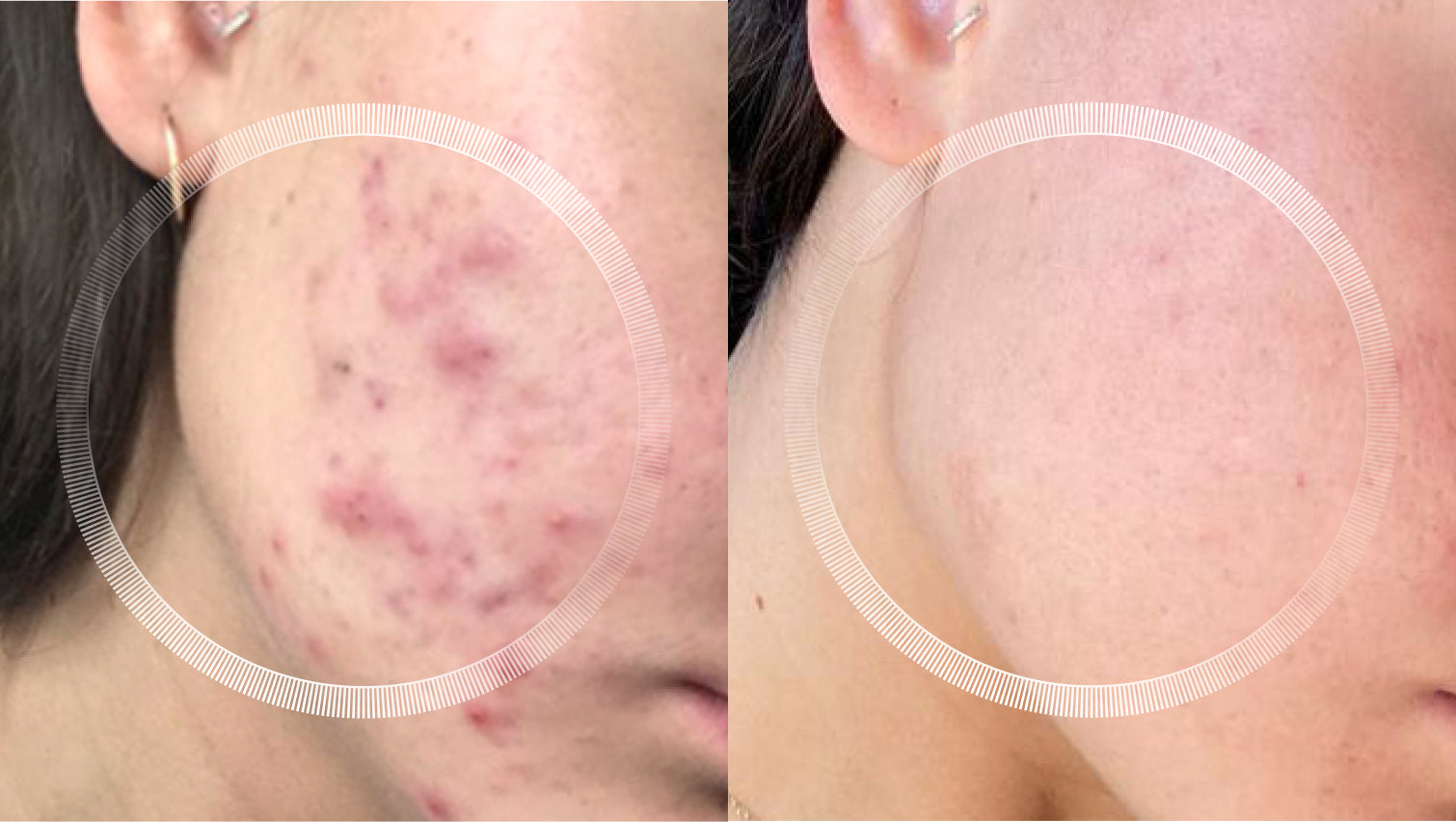 Acne treatment before and after with LYMA Laser