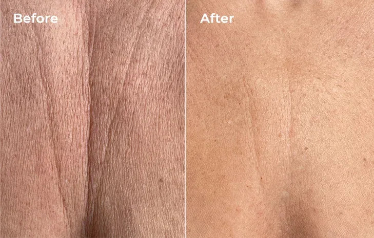 Before and after pigmentation treated with LYMA Laser on chest