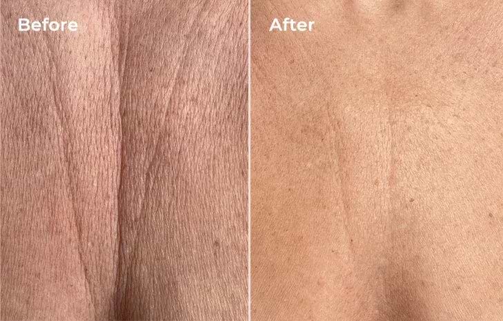 Before and after pigmentation treated with LYMA Laser on chest