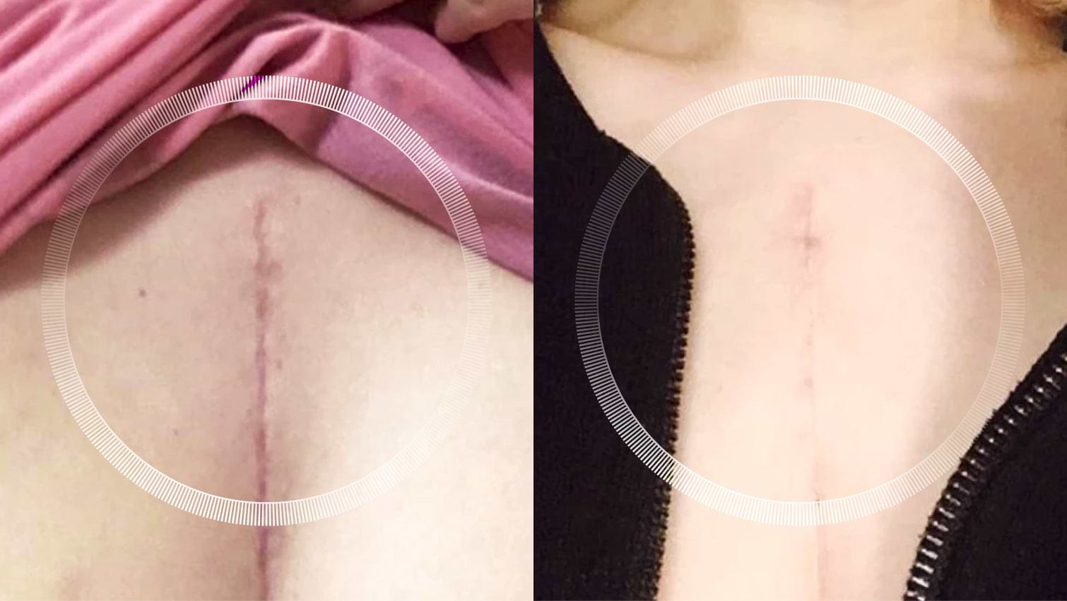 Before and after LYMA Laser chest scar reduction