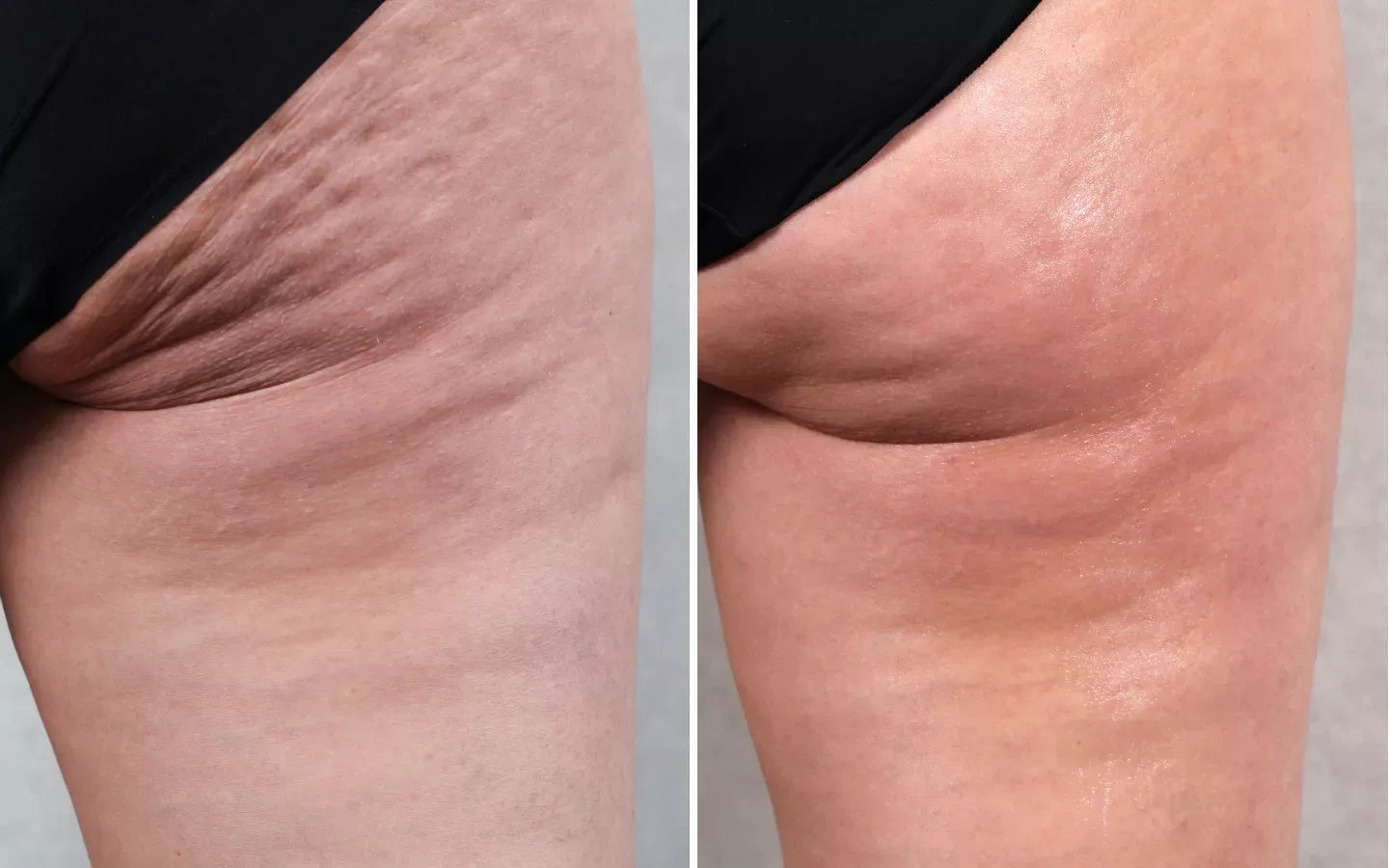 Before and after results of cellulite reduction on women’s thighs and buttocks