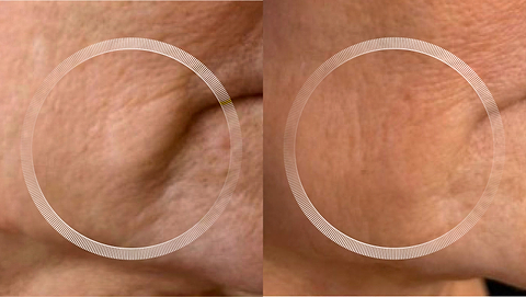 Before and after LYMA Laser skin tightening around the jowl area