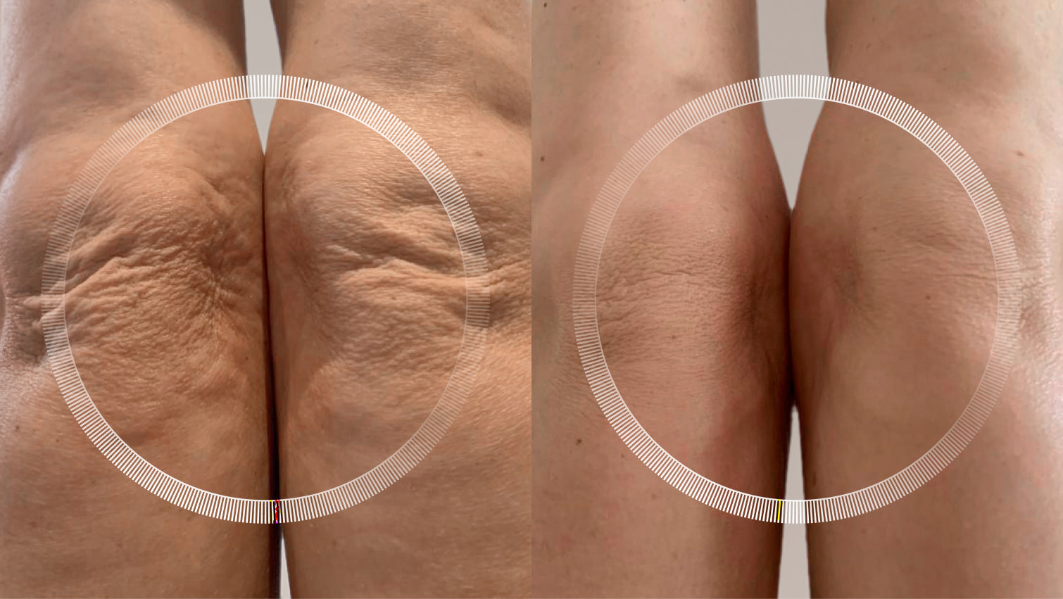 Laser skin tightening and wrinkle reduction on knee area