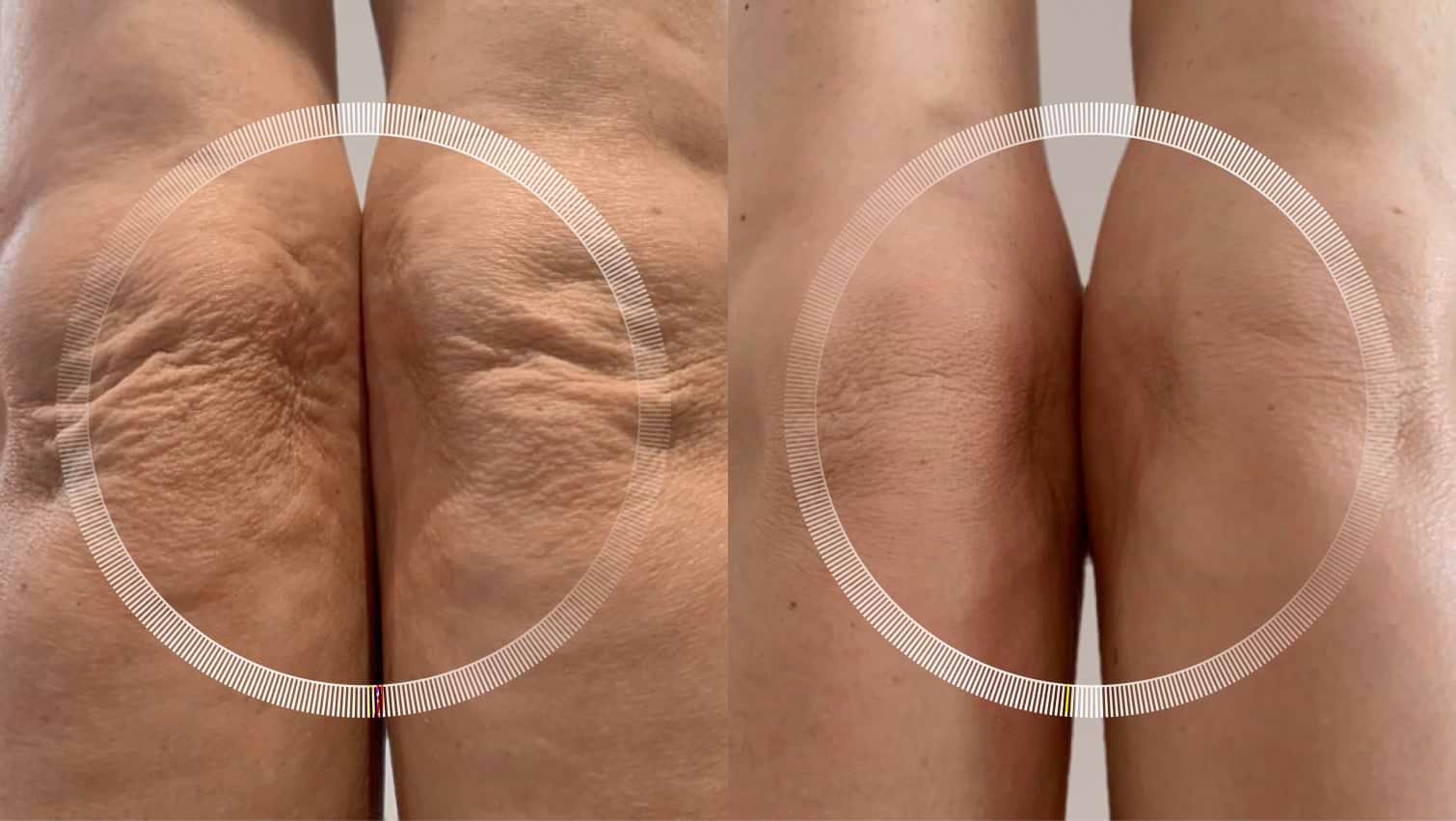 Laser skin tightening and wrinkle reduction on knee area