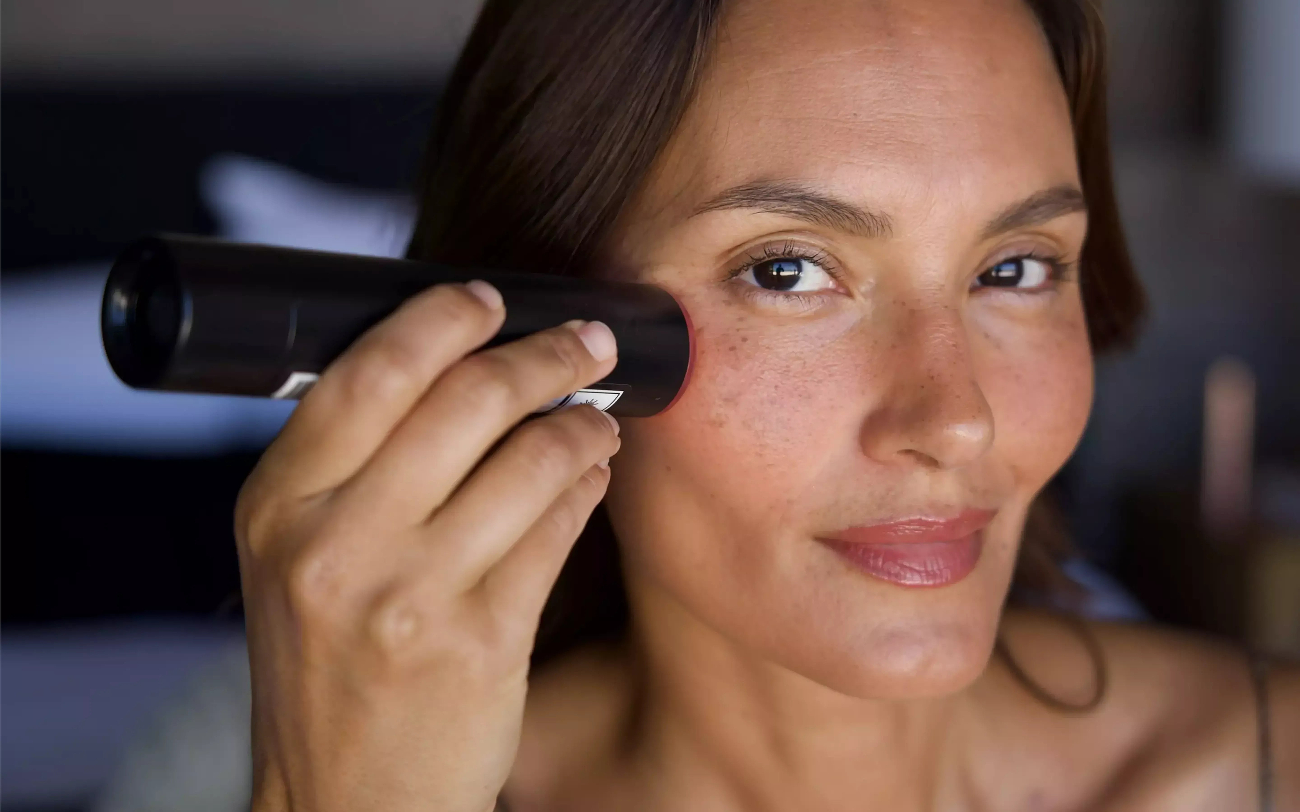 LYMA Laser treatment on sun damaged skin for pigmentation