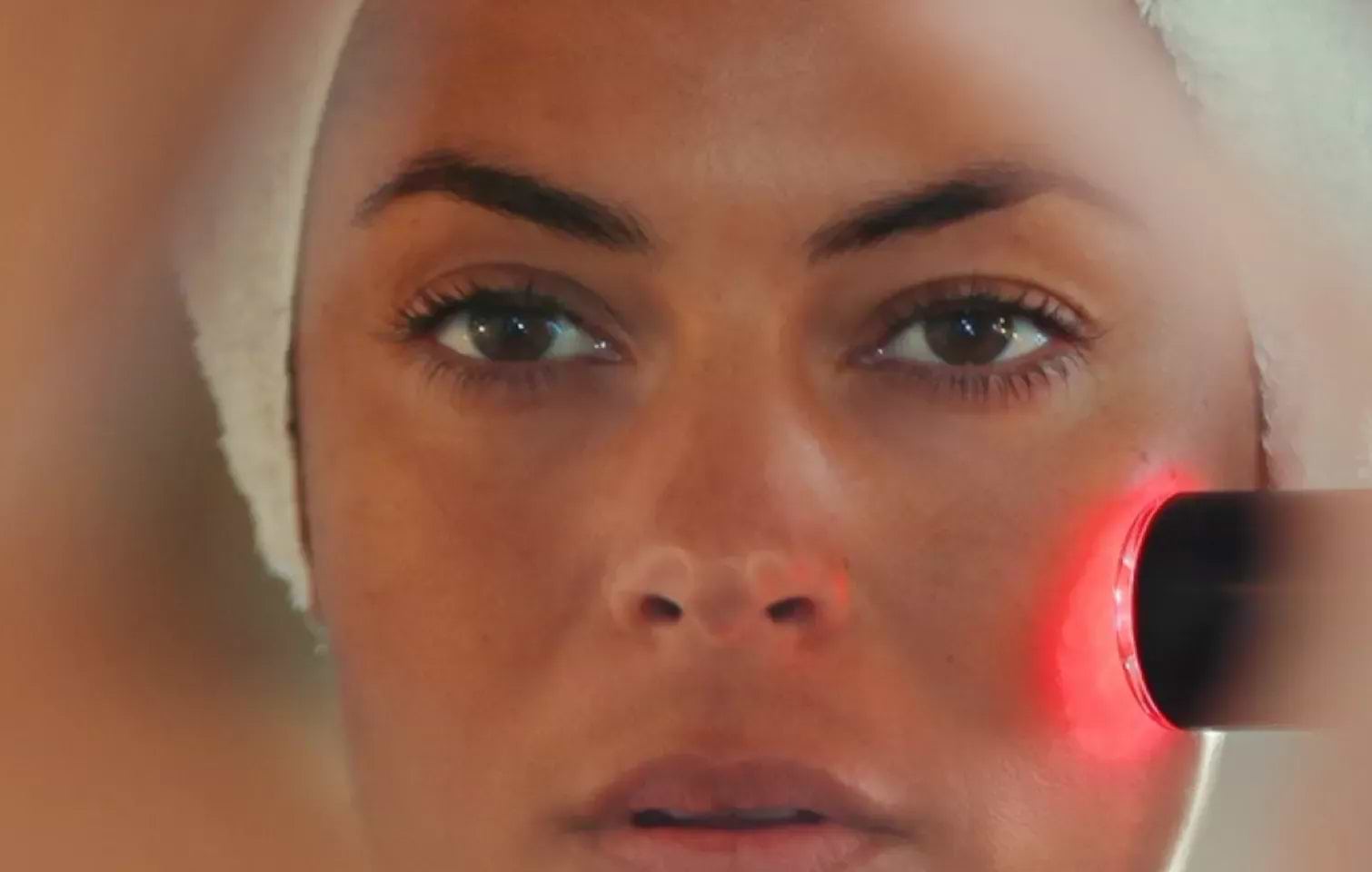 Close-up LYMA Laser treatment for forehead wrinkles
