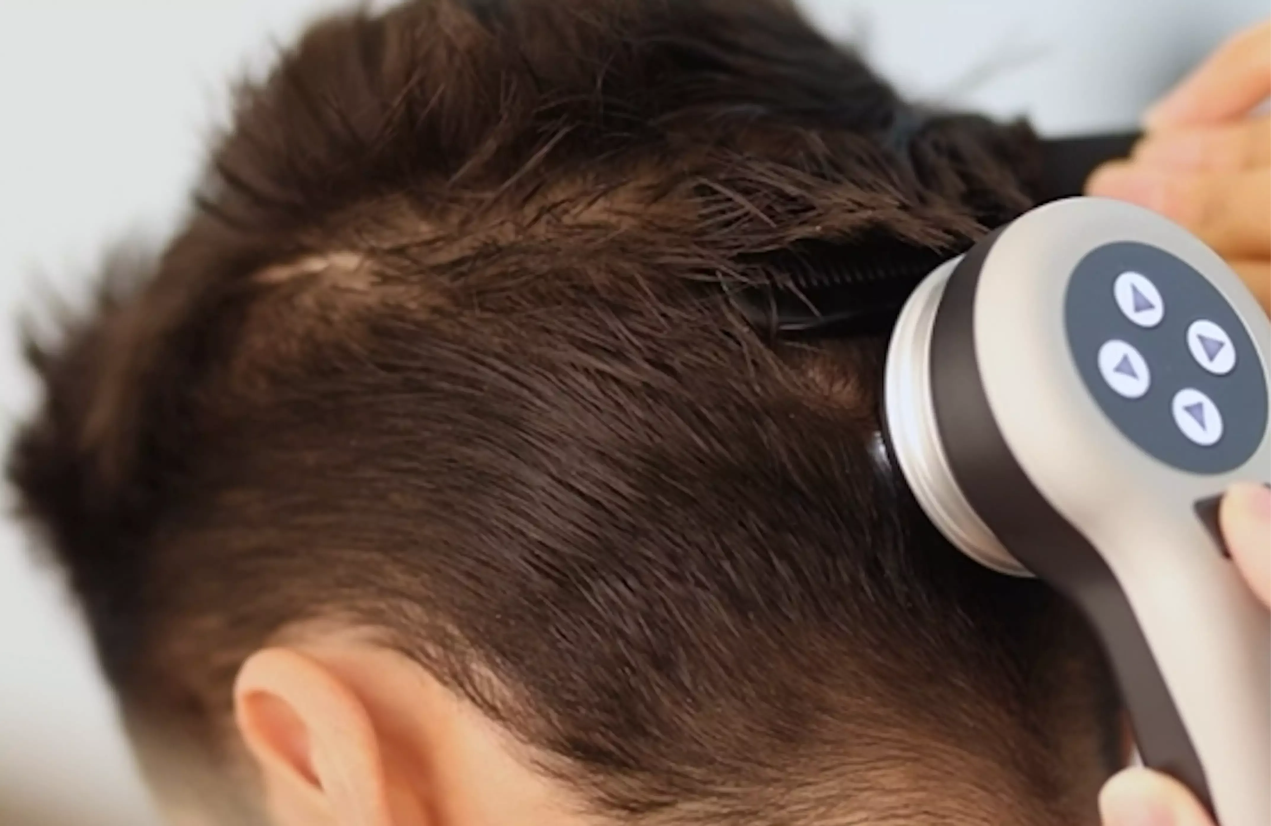 LYMA sec hugo hair loss treatment