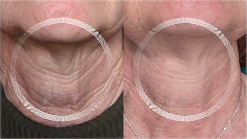 Before and after neck transformation with the LYMA Laser