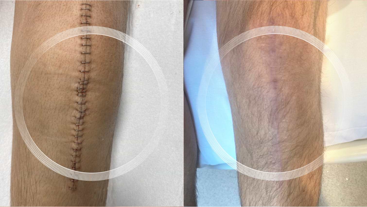 Leg scar before and after LYMA Laser treatment Leg scar before and after LYMA Laser treatment