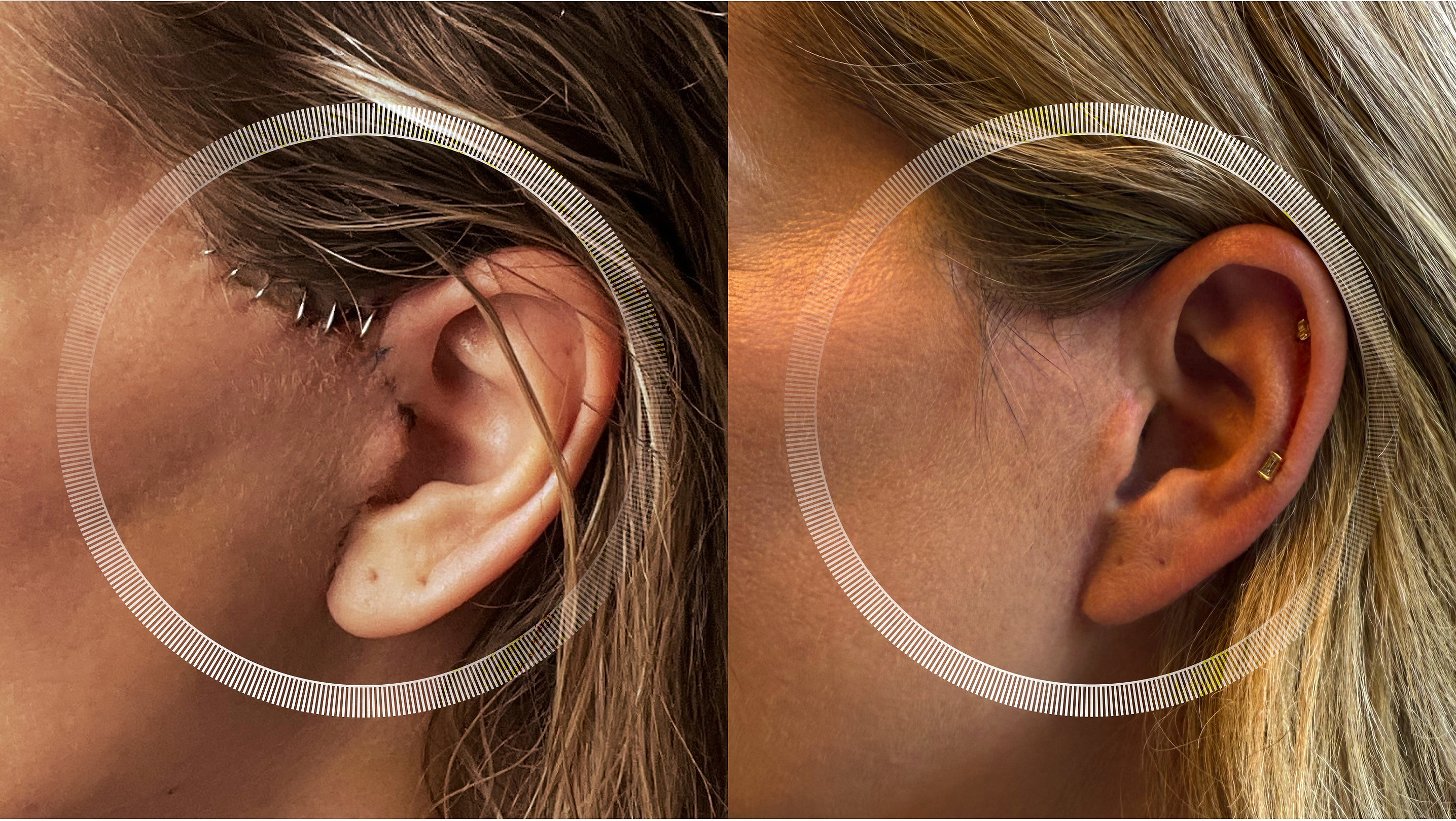 Mini facelift scars before and after using LYMA Laser PRO