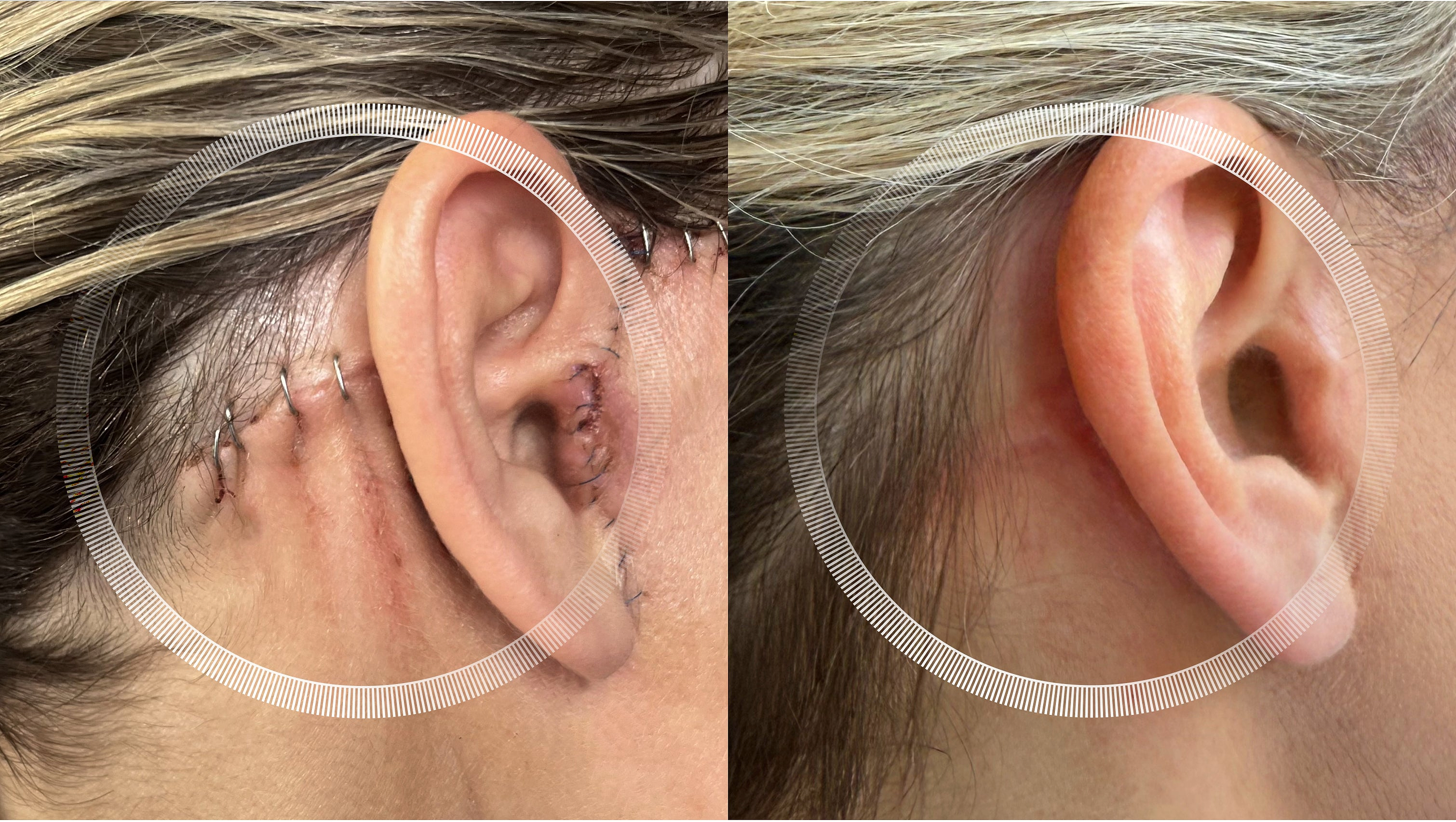 Facelift scar recovery results with LYMA Laser PRO after 3 months