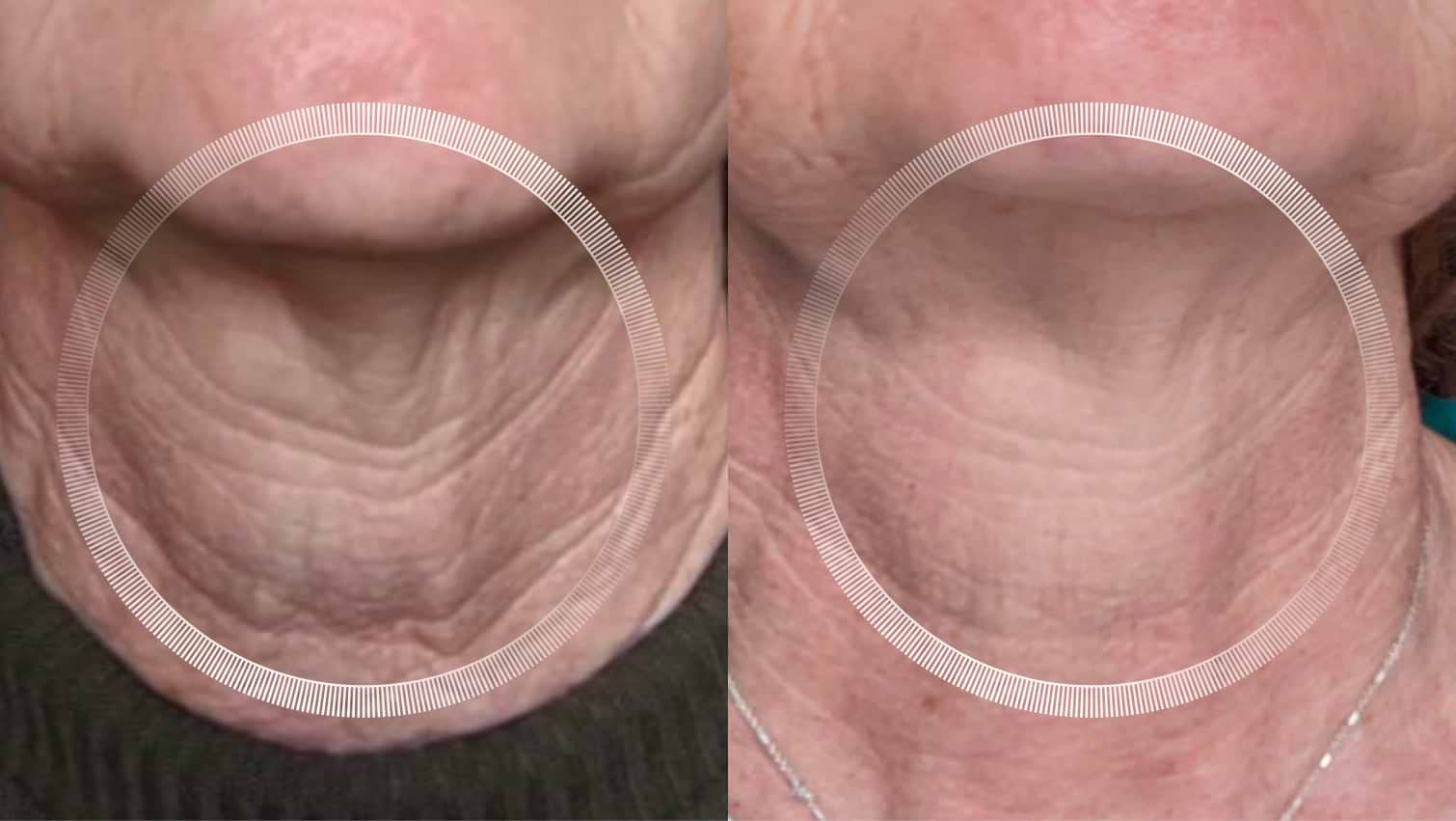 Laser neck treatment results