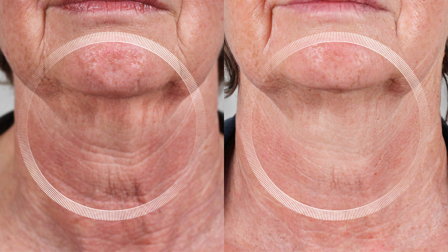 LYMA before and after neck wrinkles