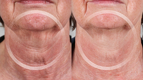 Before and after neck tightening with LYMA Laser