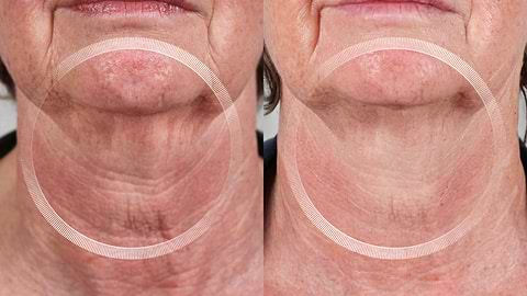 Before and after neck tightening with LYMA Laser