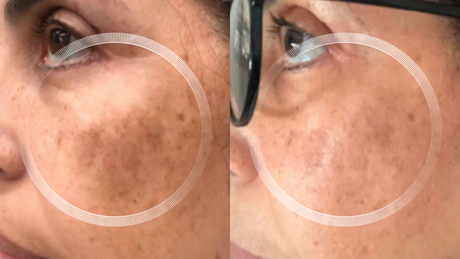 Before and after results using LYMA Laser for pigmentation and sun damage