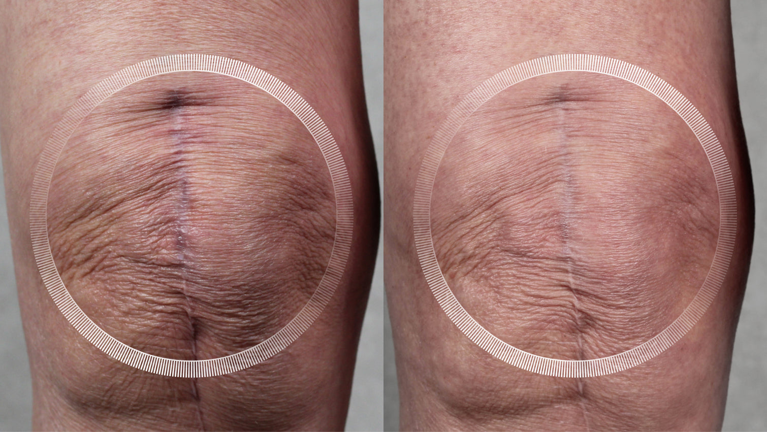 Laser treatment for scar reduction and knee skin rejuvenation