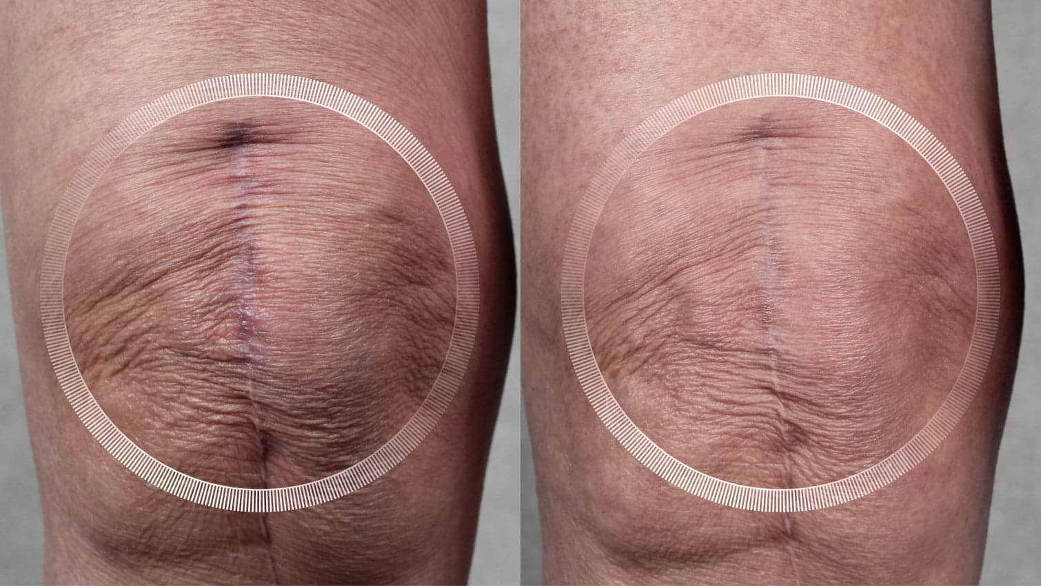 Laser treatment for scar reduction and knee skin rejuvenation