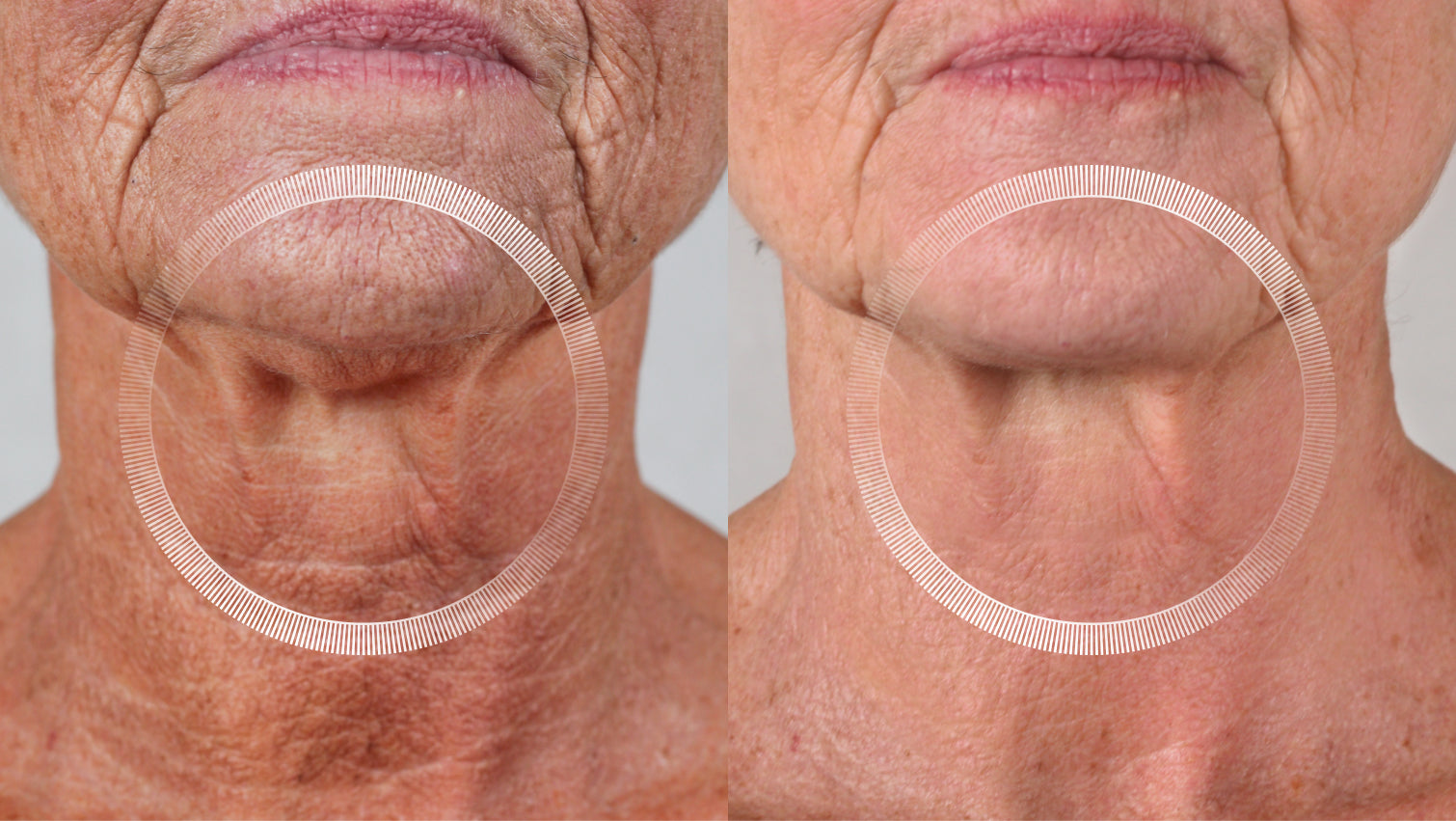 LYMA Laser PRO neck lift before and after