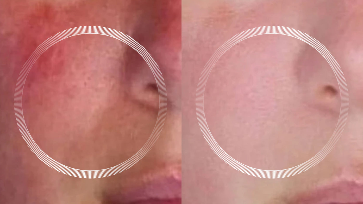 Before and after LYMA Laser treatment for rosy skin