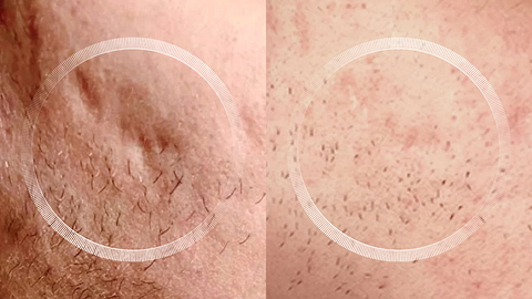 Before and after acne scar healing with LYMA Laser treatment