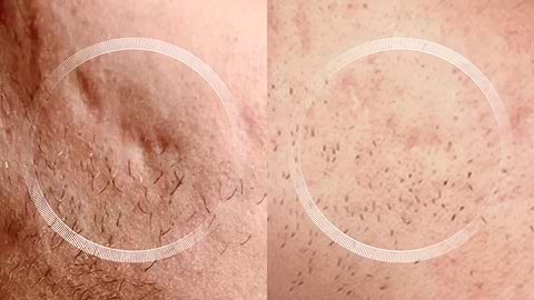 Before and after acne scar healing with LYMA Laser treatment