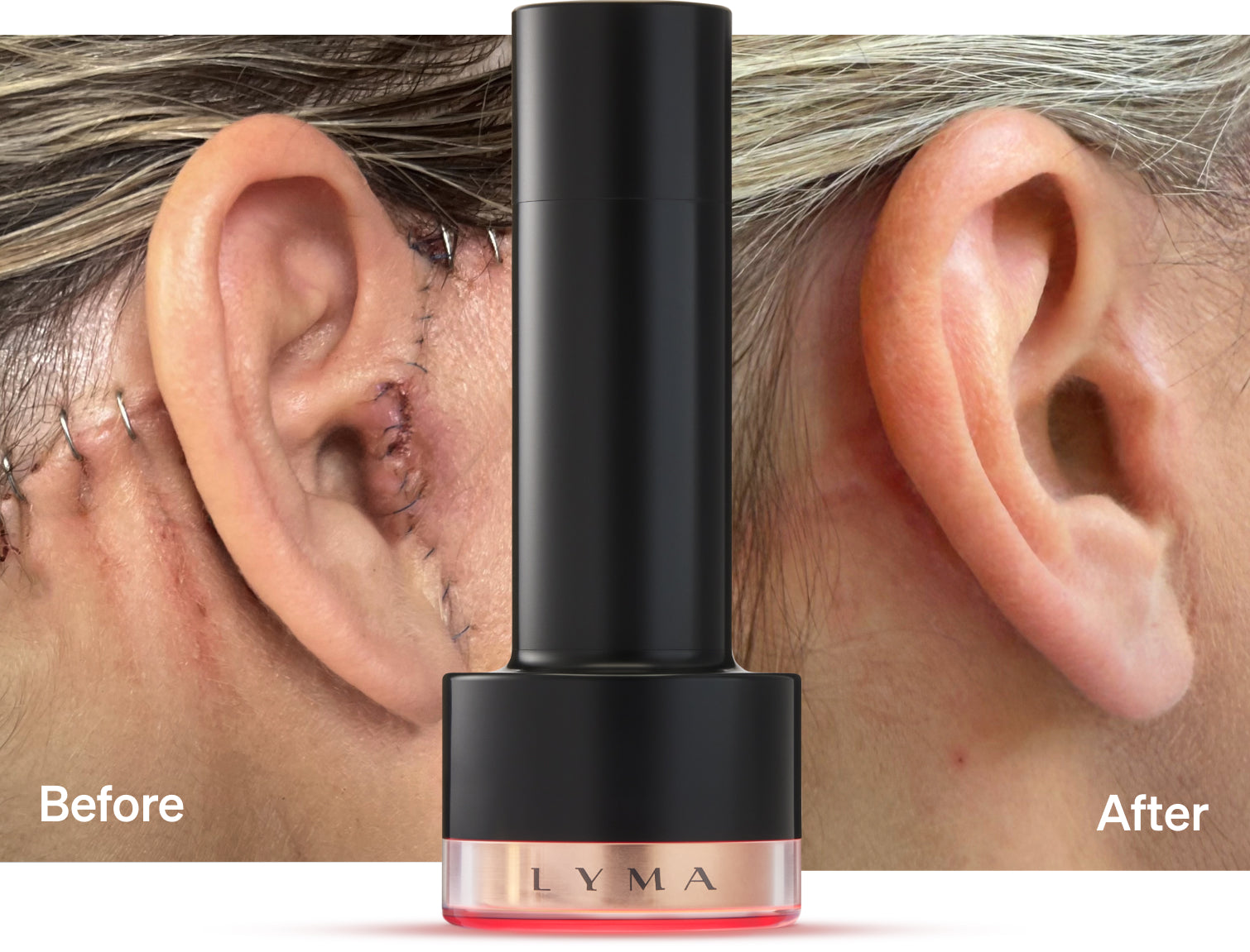 Before and after laser skin treatment results with LYMA Laser product