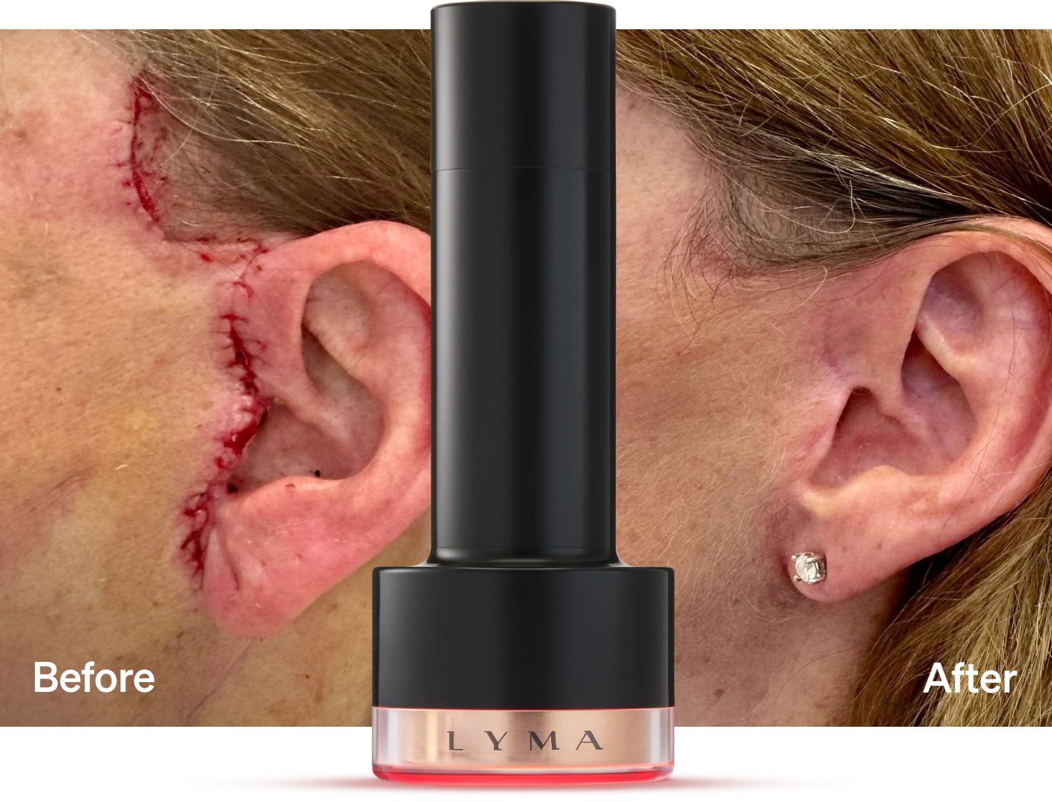 LYMA Laser PRO before and after results for scar removal by laser treatment