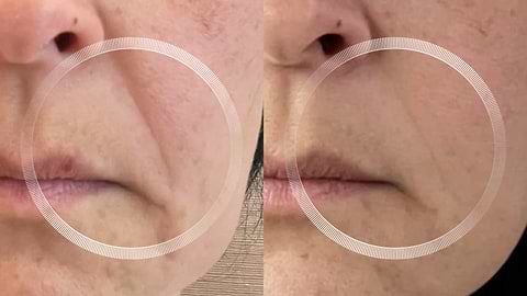 Before and after LYMA Laser treatment for wrinkles around the mouth