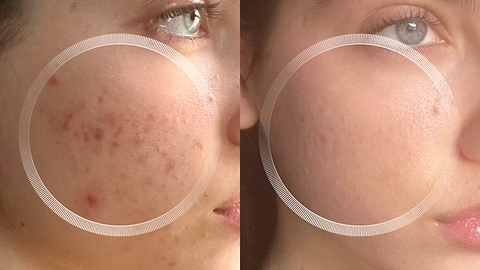 Acne scar treatment with LYMA Laser at home