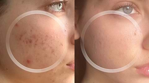 Acne scar treatment with LYMA Laser at home