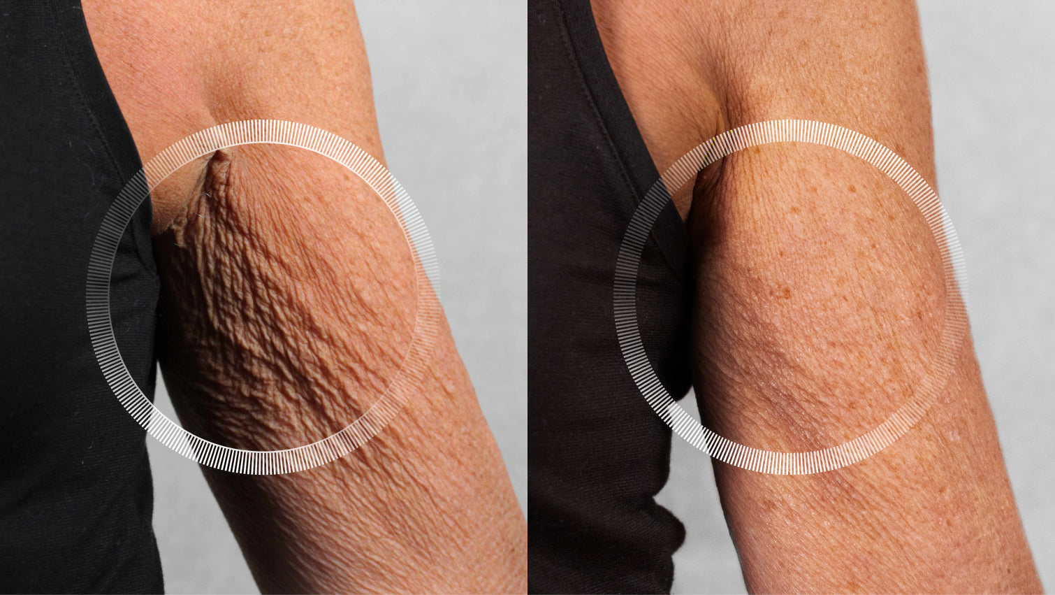 Laser wrinkle treatment and skin rejuvenation on arm area