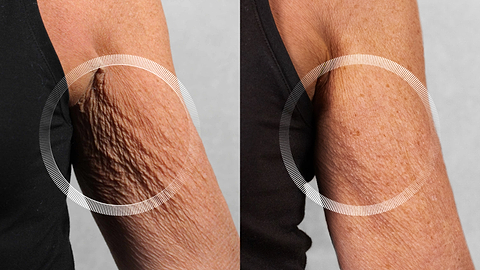 Before and after LYMA Laser on underarm showing smoother skin