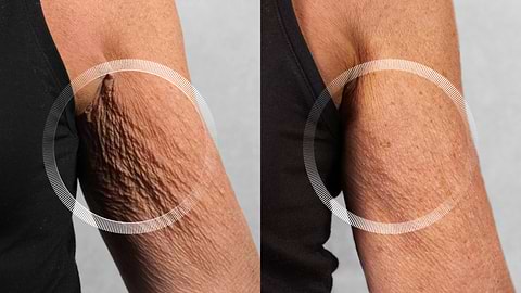 Before and after LYMA Laser on underarm showing smoother skin
