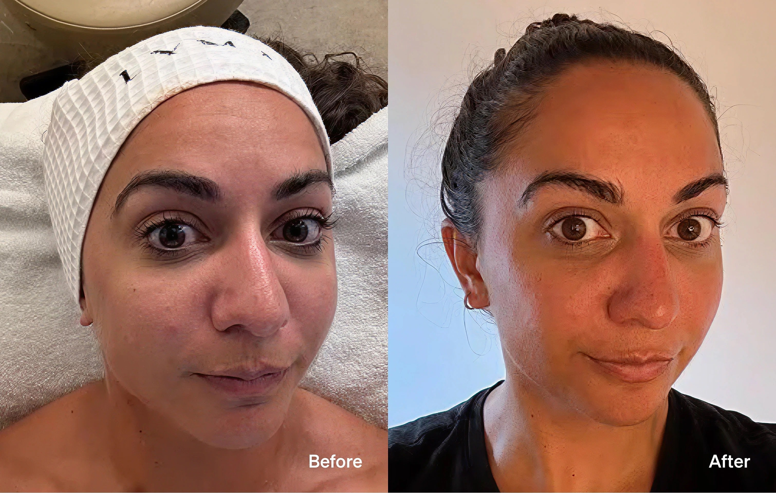 Before and after LYMA Lift non-surgical facelift results