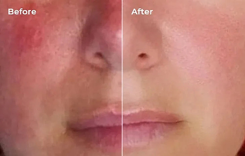 Before and after LYMA Laser rosacea treatment results