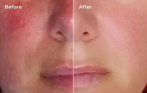 Before and after LYMA Laser rosacea treatment results
