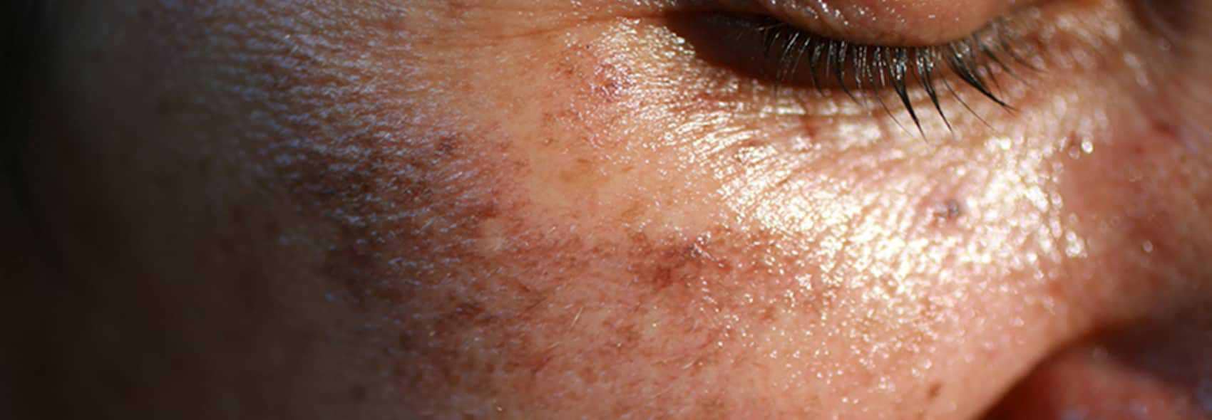 pigmentation photo