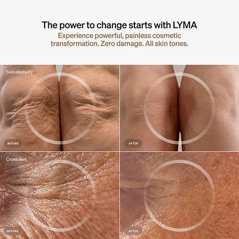 LYMA Laser device for red light and near-infrared therapy