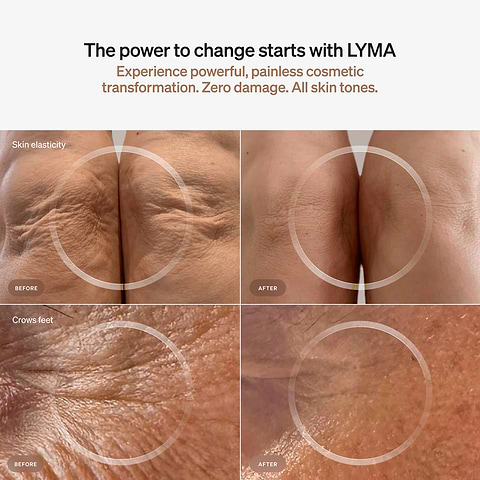 LYMA Laser device for red light and near-infrared therapy