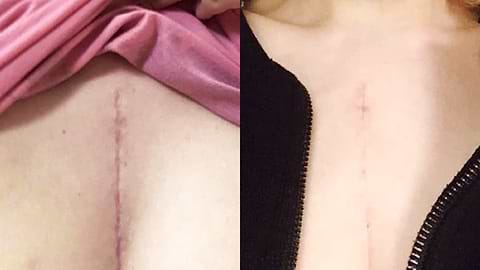 Before image of C-section scar on chest