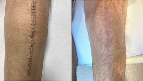 Before image of scar on knee prior to LYMA Laser treatment
