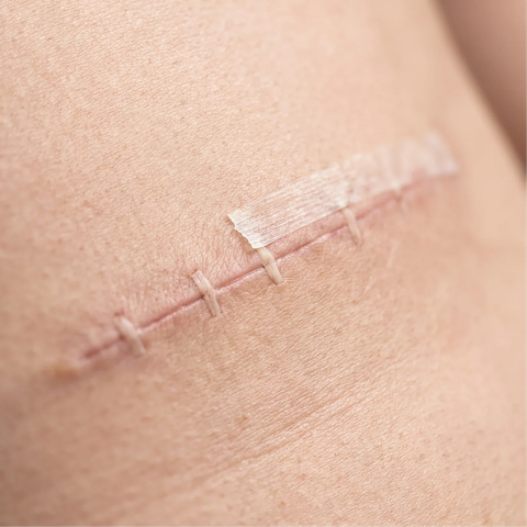 Body contouring after significant weight loss